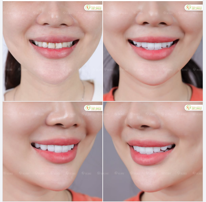 NGẠI GIAO TIẾP VÌ HÀM RĂNG XỈN MÀU VÀ KẾT QUẢ NGOÀI MONG ĐỢI KHI ĐẾN VIET SMILE