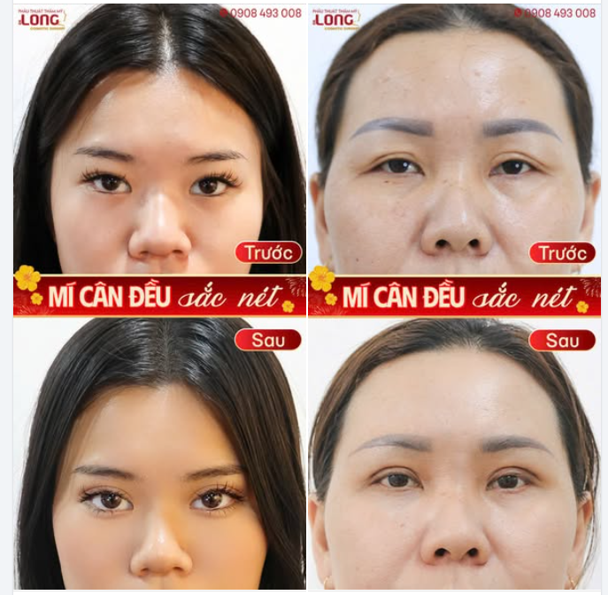 Cân chỉnh nếp mí “điểm chạm” cho ánh nhìn rạng rỡ ngày Xuân