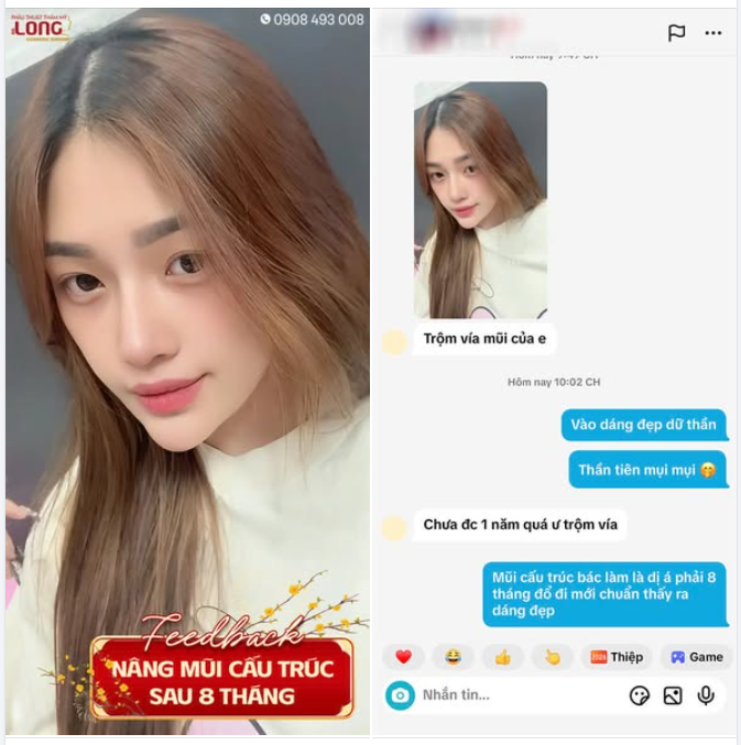 FEEDBACK SAU 8 THÁNG LÀM MŨI CẤU TRÚC CÀNG NHÌN CÀNG YÊU