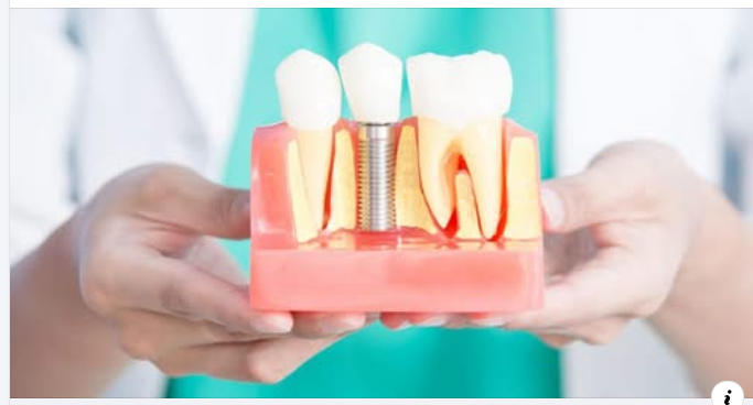 9 lợi ích của việc cấy ghép Implant