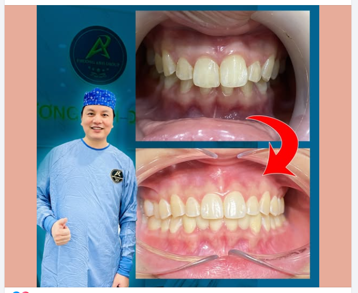 Cách Chăm Sóc Để Răng Sứ Tồn Tại Lâu Dài Hơn