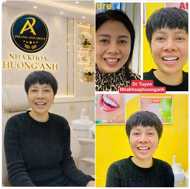 Kiến tạo nụ cười cho chị đẹp! Combor: Chỉnh nha invisalign + Dán sứ Veneer toàn hàm.