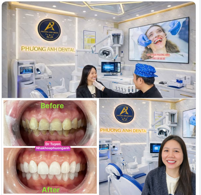 RĂNG ĐẸP ĐÓN XUÂN!  Hành trình làm răng thẩm mỹ – Quyết định đúng đắn nhất khi về Việt Nam