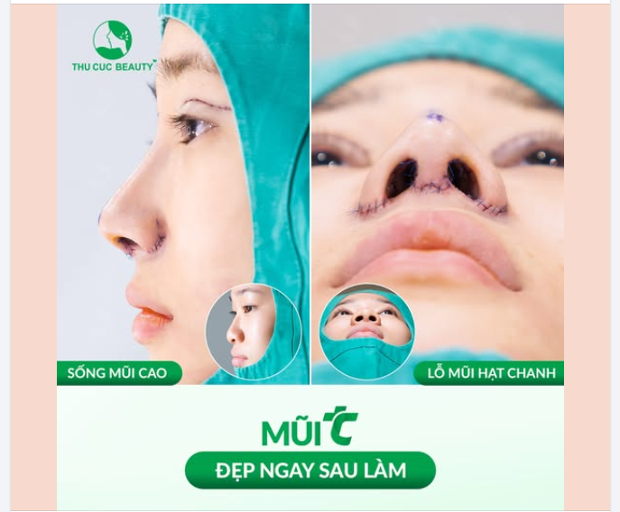 Mũi TC Dáng cao thon, lỗ mũi hạt chanh ngay sau làm
