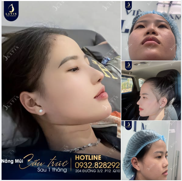 TỪ BIẾN CHỨNG MŨI CHỈ ĐẾN DÁNG MŨI CẤU TRÚC HOÀN HẢO SAU 1 THÁNG