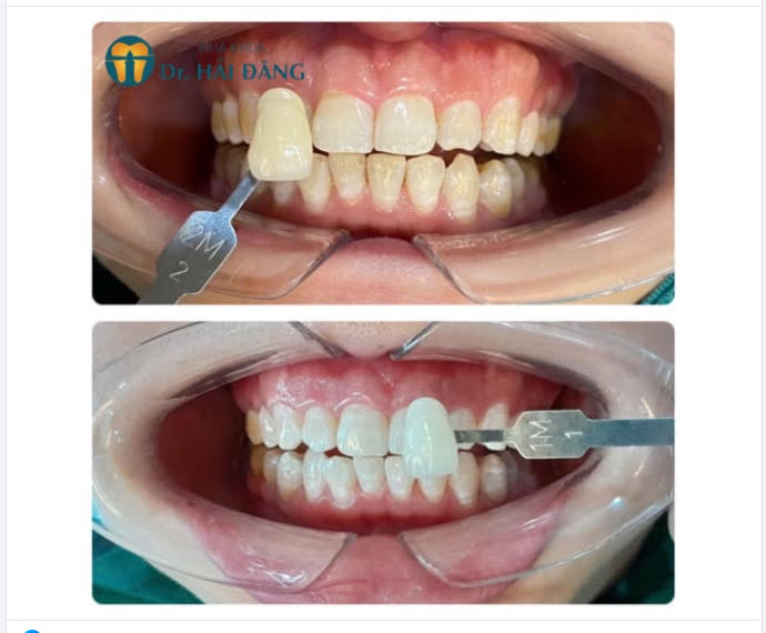 TRƯỚC SAU KHI TẨY TRẮNG RĂNG – KHÁCH HÀNG BÍCH PHƯƠNG