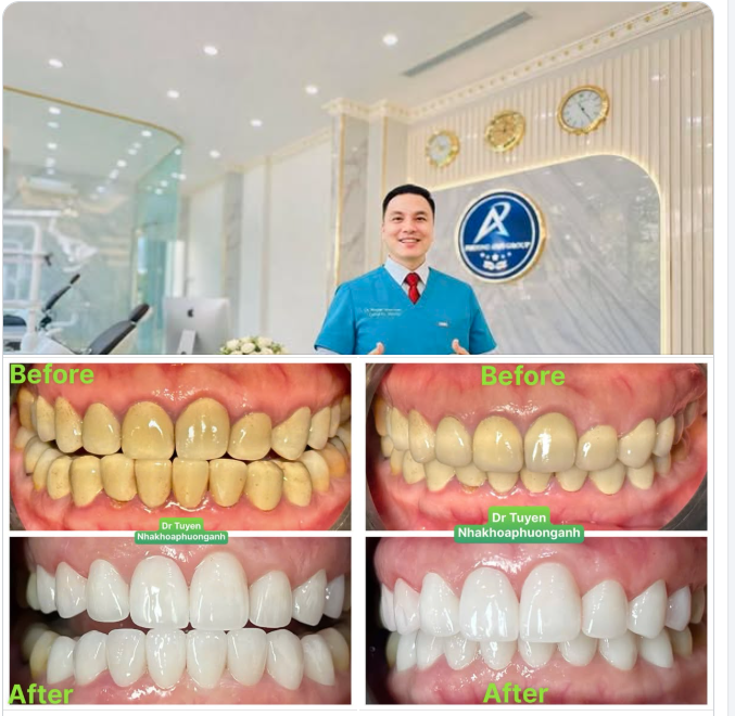 RĂNG SỨ KIM LOẠI NHỮNG TÁC DỤNG PHỤ: