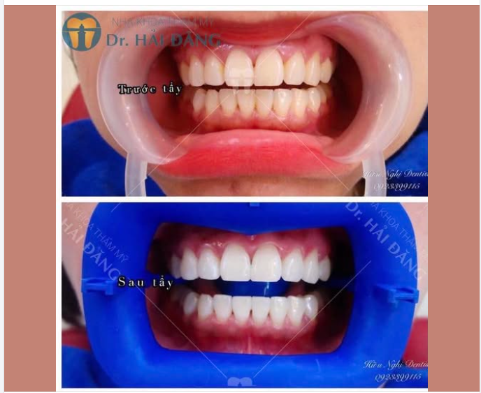 TẨY TRẮNG RĂNG ƯU ĐÃI KHỦNG – ĐỪNG BỎ LỠ!