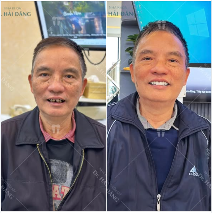 BỌC 20 RĂNG SỨ – NỤ CƯỜI THAY ĐỔI, CUỘC SỐNG KHÁC BIỆT