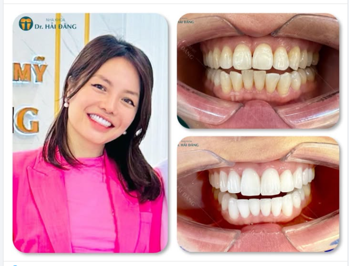 ĐỪNG LƯỚT QUA NẾU BẠN ĐANG MUỐN LÀM RĂNG ĐẸP THẬT SỰ!