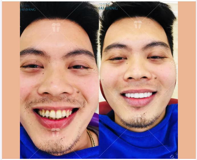 Trước đây anh Khánh hơi xỉn màu – răng khấp khểnh nhẹ, cười chưa được tự tin.