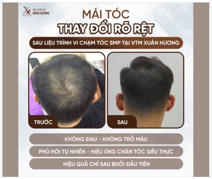 MÁI TÓC THAY ĐỔI RÕ RỆT sau liệu trình VI CHẠM TÓC SMP tại VTM XUÂN HƯƠNG