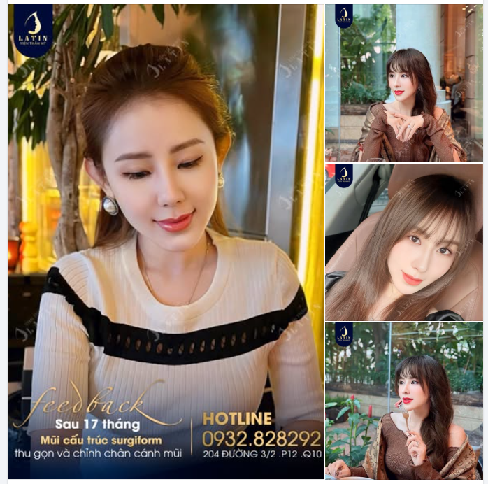 MŨI SURGIFORM CÀNG ĐỂ LÂU CÀNG ĐẸP TỰ NHIÊN