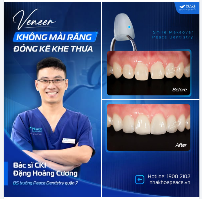 VENEER KHÔNG MÀI RĂNG BẢO TỒN RĂNG THẬT TỐI ĐA