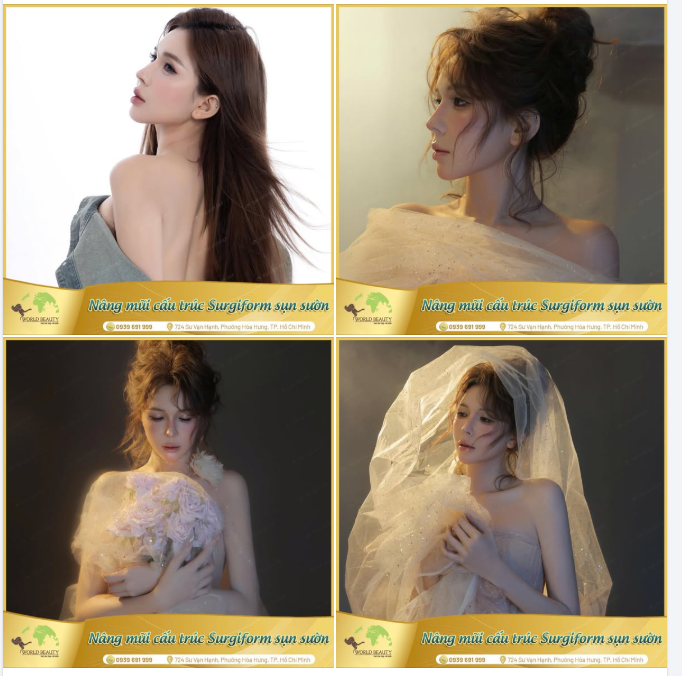 Khi vẻ đẹp an toàn và bền vững cuối cùng cũng mỉm cười với Quý Cô – sau lần tái ph.ẫu th.uật mũi cấu trúc lần thứ 3 bằng sụn sườn tự thân