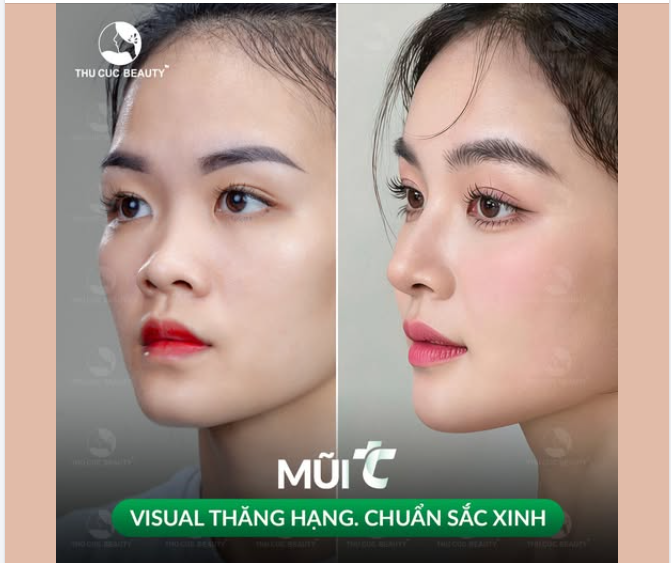 ​​​​​​​Nâng mũi TC Không đau. Không bầm tím
