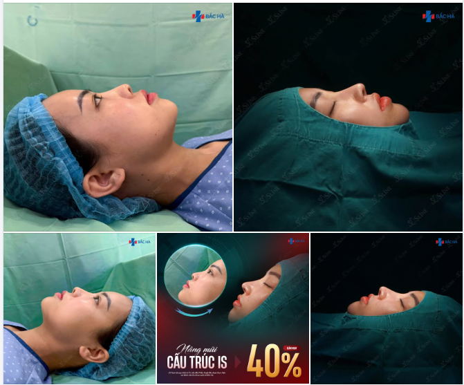 ƯU ĐÃI CUỐI NĂM – NÂNG MŨI CẤU TRÚC GIẢM TỚI 40%