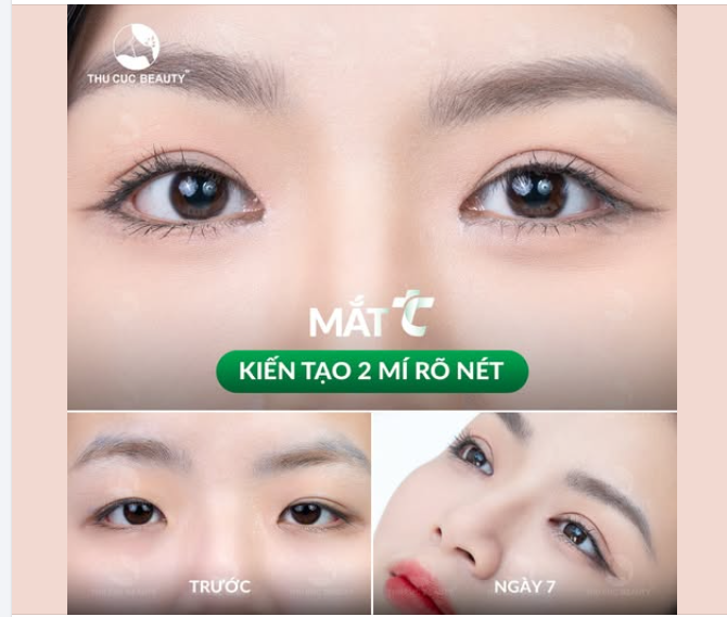 Muốn đôi mắt có hồn nhưng mí sụp lại không cho phép
