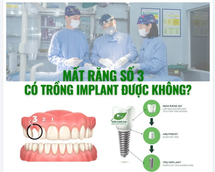 MẤT RĂNG SỐ 3 – CÓ TRỒNG IMPLANT ĐƯỢC KHÔNG?