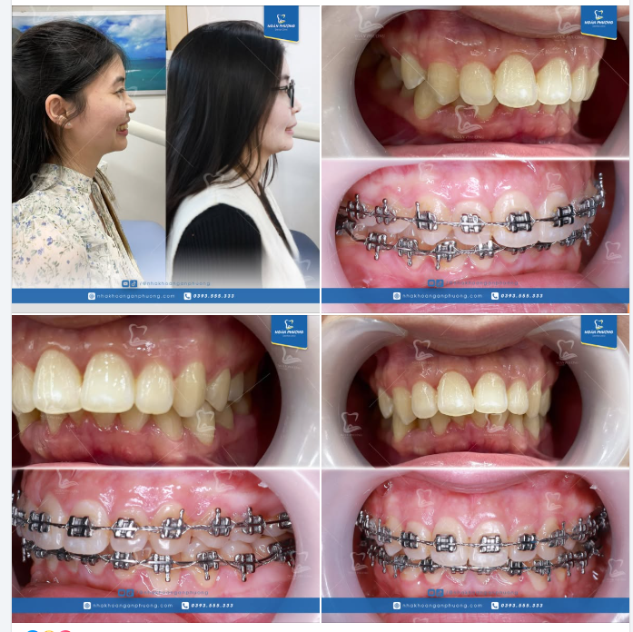 Từ răng chìa, cắn sâu, bạn ấy đã thật sự sở hữu răng khỏe, nụ cười đẹp, góc nghiêng duyên dáng như mong đợi