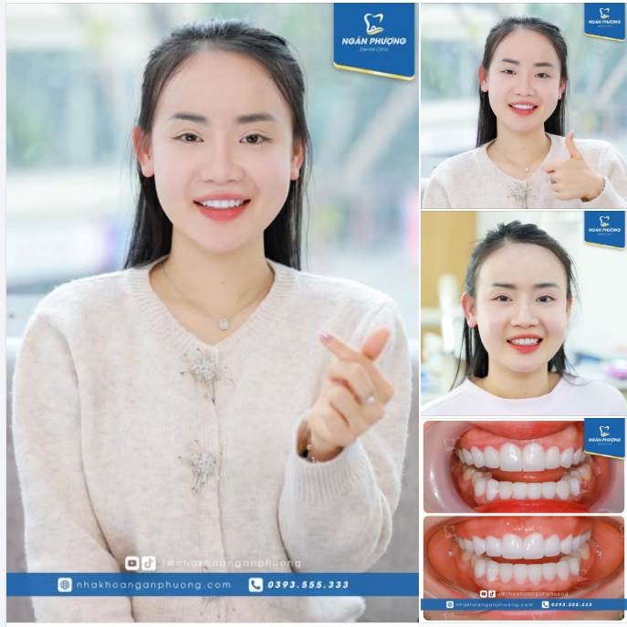 Làm lại răng sứ (tại nha khoa khác) do gặp vấn đề về viêm lợi, nhưng chị Hải Anh đã nhận lại nhiều hơn thế: