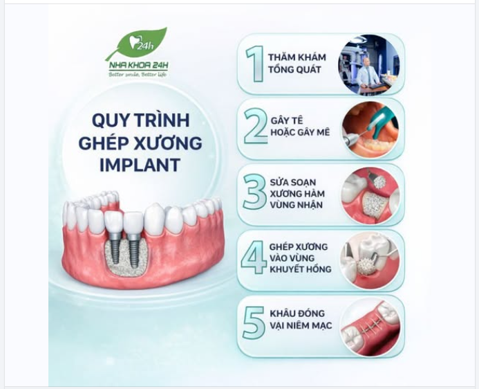 Góc bác sĩ chia sẻ: Vì sao ghép xương lại quan trọng trước khi trồng Implant?