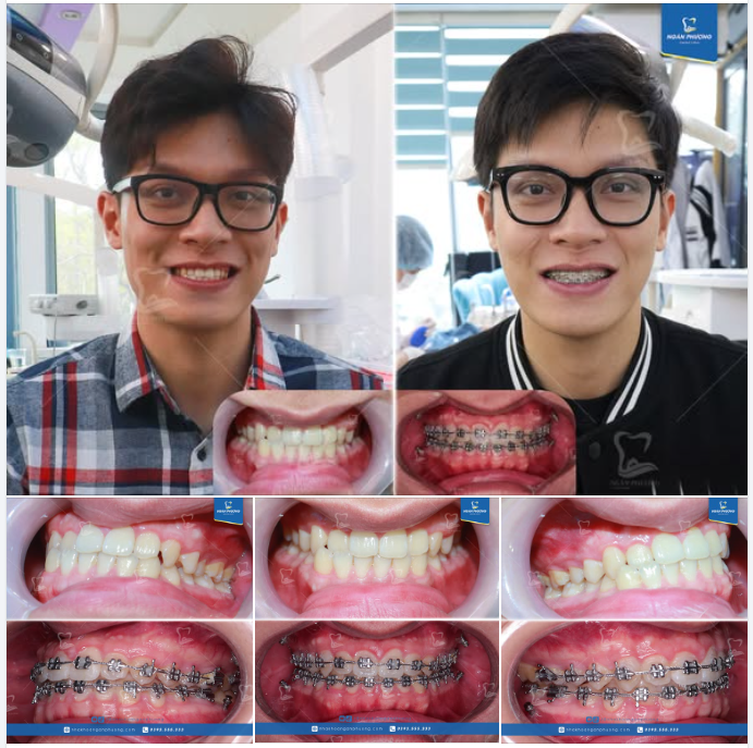 Tháo niềng đón Tết, trọn niềm vui