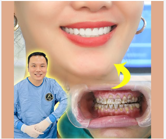 Những lưu ý sau khi làm răng sứ thẩm mỹ