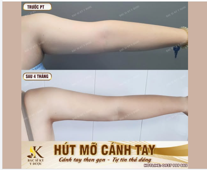 Cánh tay thon gọn - Tự tin thả dáng