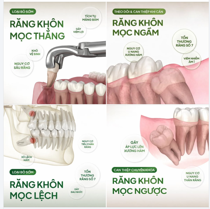 BẠN CÓ BIẾT RĂNG KHÔN CỦA MÌNH ĐANG Ở TÌNH TRẠNG NÀO KHÔNG?