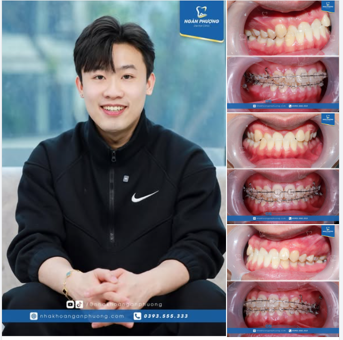 Nhả vía tháo niềng đón Tết siêu đẹp trai của Ngọc Khang đến mọi nhà