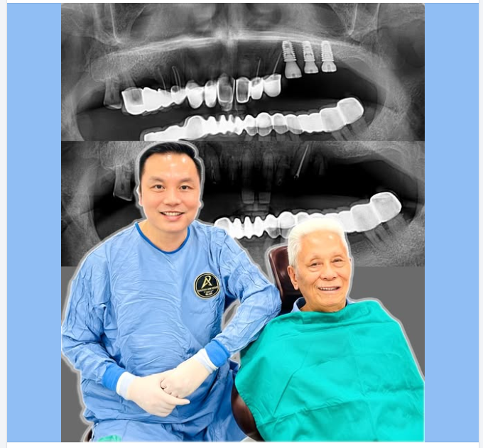 Cấy ghép Implant là gì? Có nên cấy Implant không?