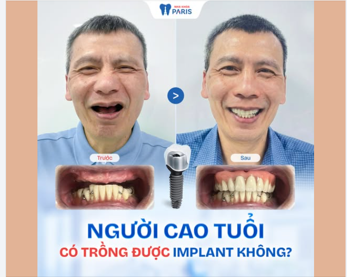 NGƯỜI CAO TUỔI CÓ TRỒNG RĂNG IMPLANT ĐƯỢC KHÔNG?