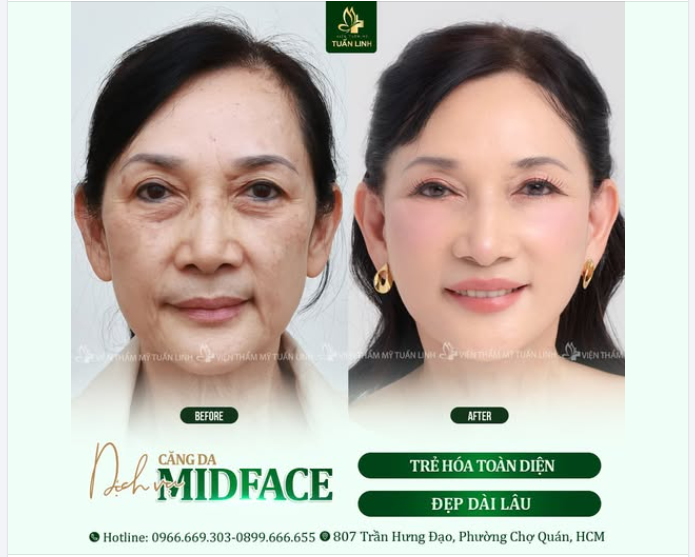 CĂNG DA MIDFACE - TRẺ HÓA TOÀN DIỆN - ĐẸP DÀI LÂU!!