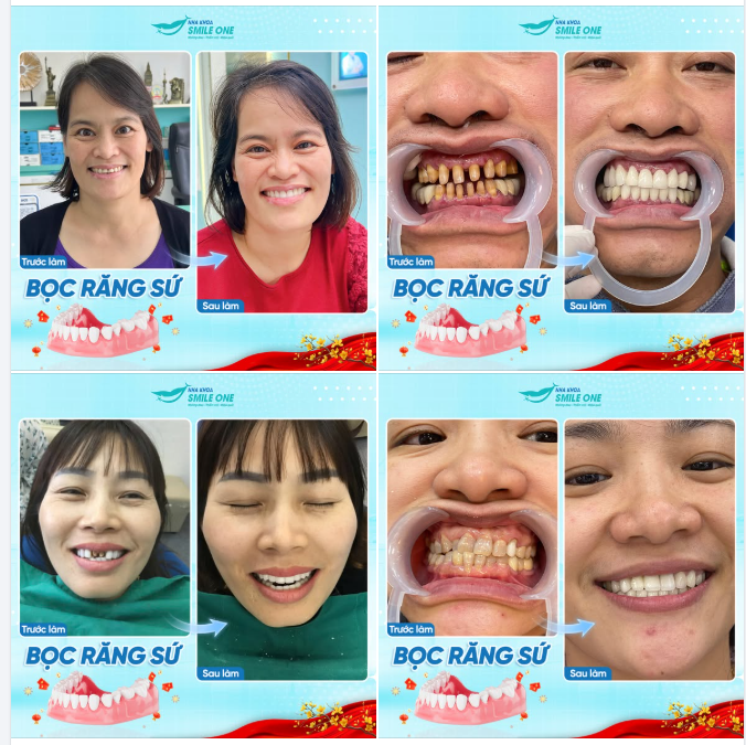 BỌC SỨ THẨM MỸ NÂNG TẦM NỤ CƯỜI - RẠNG RỠ ĐÓN TẾT