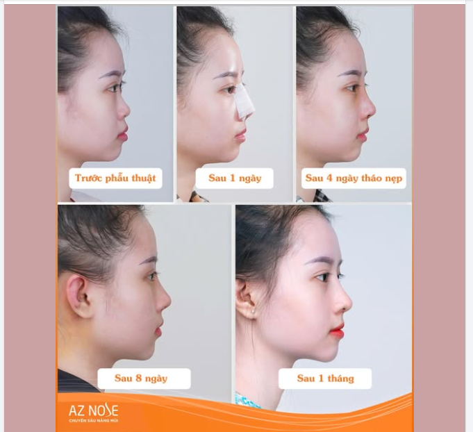 Quá trình mũi nhà AZNOSE vào form đây ạ