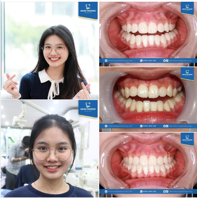 Tháo niềng răng đẹp 10/10, đồng niềng ơi, gắn mắc cài ngay thôi