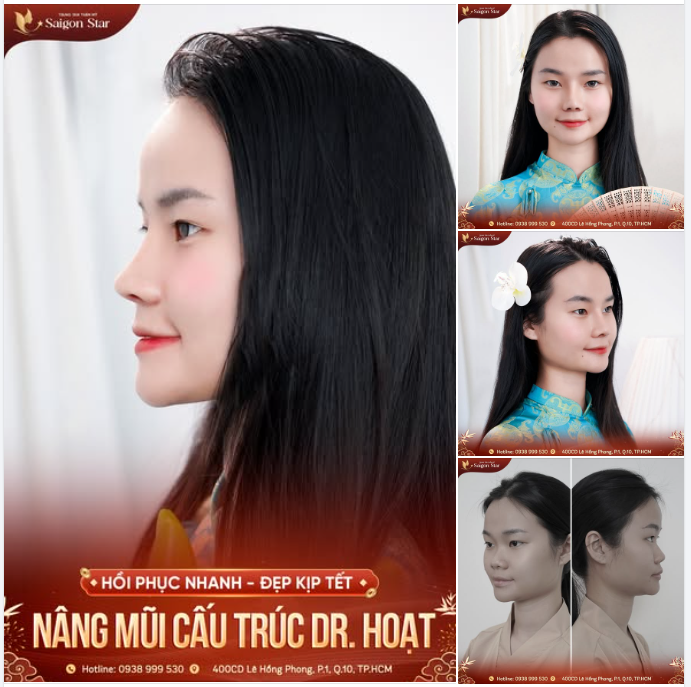 MŨI ĐẸP KỊP TẾT - RẠNG NGỜI ĐÓN XUÂN  NÂNG MŨI CẤU TRÚC DR. HOẠT 10 NGÀY HỒI PHỤC