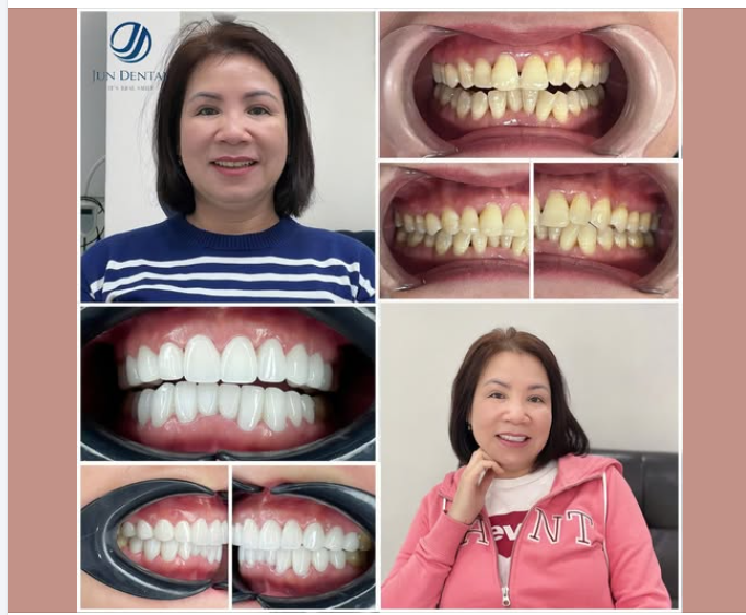 LÀM RĂNG ĐÓN TẾT – ĐỔI NỤ CƯỜI, ĐỔI DIỆN MẠO