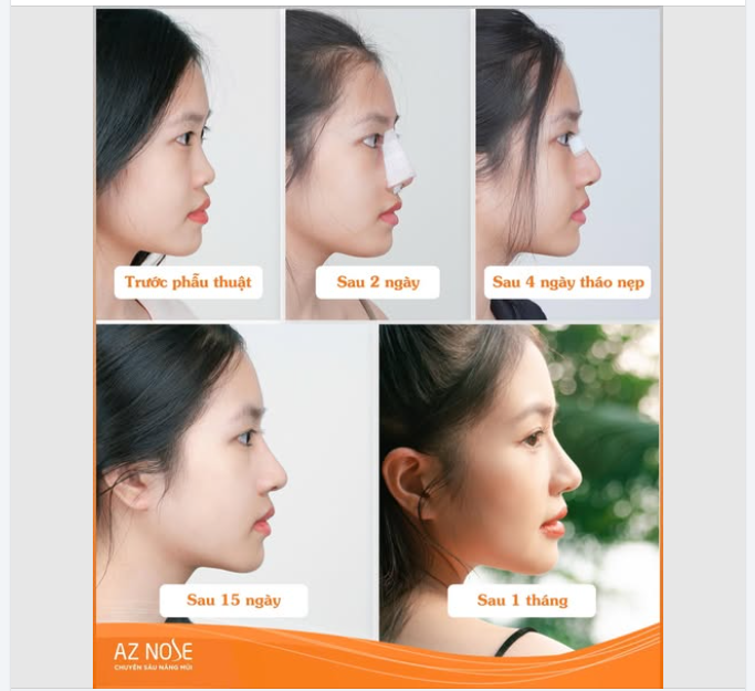 Tự nhiên và hài hòa - Nếu dáng mũi này "đúng gu" của bạn thì nhắn AZNOSE ngay nhé!