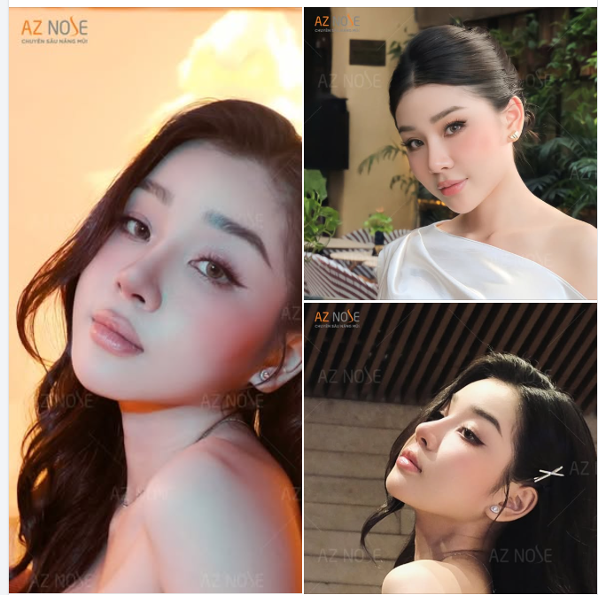 Top 20 Miss Grand Vietnam 2025 - Tường Vi sau 2 tháng nâng mũi