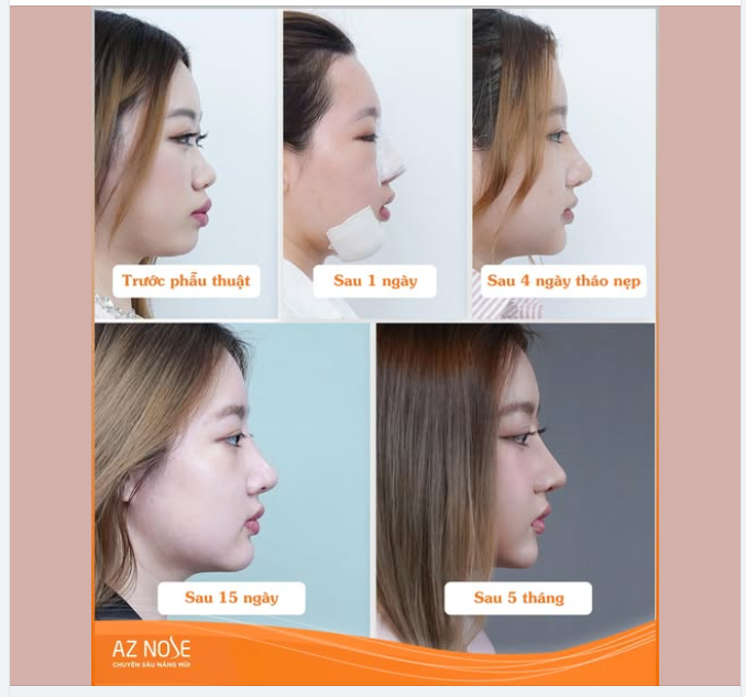 Mũi cằm vào form - góc nghiêng sắc nét, thần thái thăng hạng. Thay đổi NGAY cùng AZNOSE!!