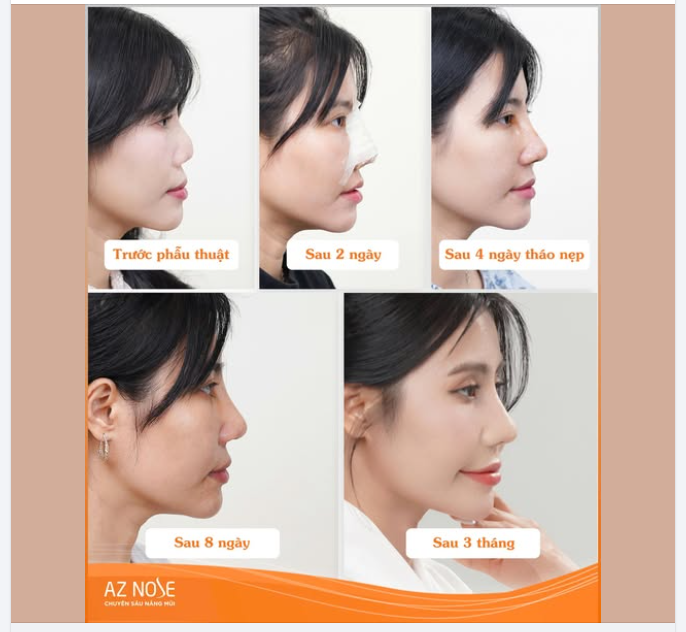 Khắc phục đầu mũi co rút sau 2 lần sửa h..ỏng cho khách hàng Khánh Hoà. Nhắn để được tư vấn!