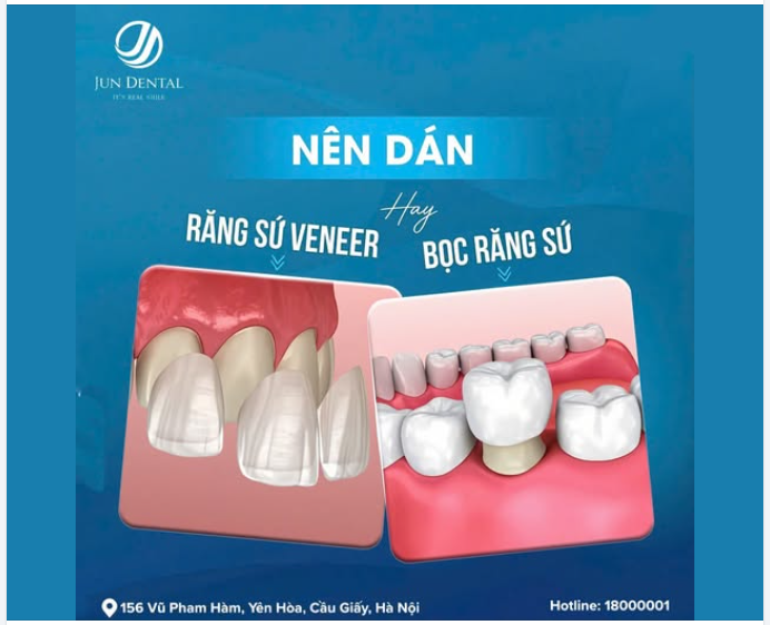 KHI NÀO NÊN BỌC SỨ – KHI NÀO NÊN DÁN SỨ VENEER?