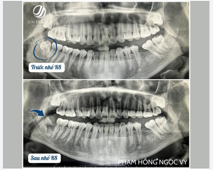 CA LÂM SÀNG: NHỔ RĂNG KHÔN R48  LẬP KẾ HOẠCH CẤY IMPLANT R36  KHÁCH HÀNG PHẠM NGỌC HỒNG VY – JUNDENTAL