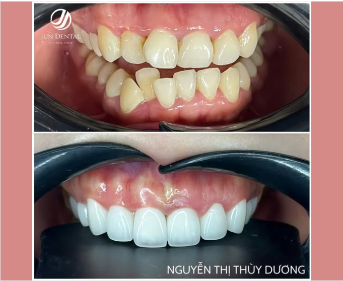 BỌC 10 RĂNG SỨ THẨM MỸ – HOÀN THIỆN NỤ CƯỜI ĐÓN TẾT