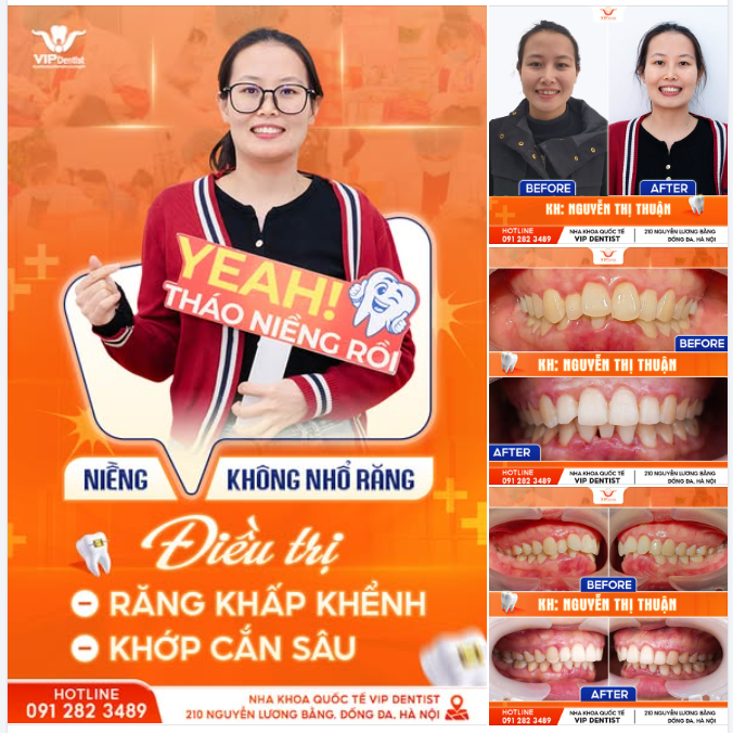 PHÁC ĐỒ HIỆU QUẢ - GIẢI KHỚP CẮN SÂU SAU 24 THÁNG