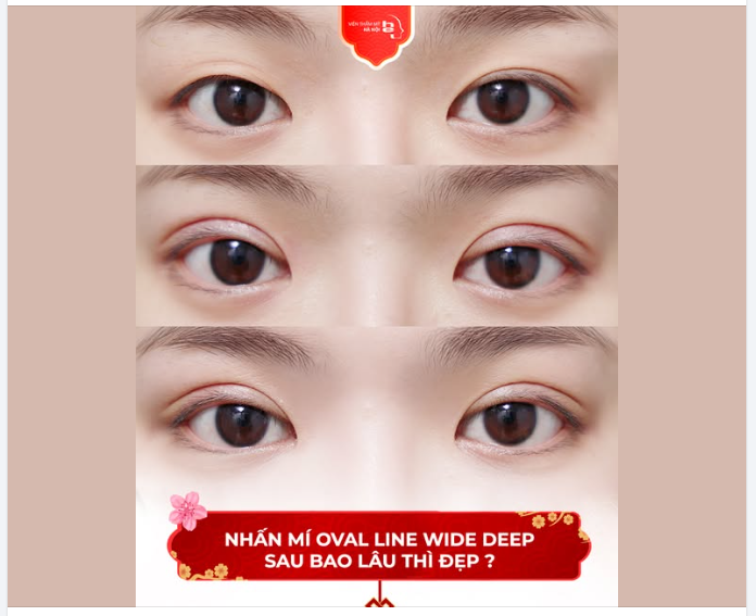 NHẤN MÍ OVAL LINE WIDE DEEP SAU BAO LÂU THÌ ĐẸP?
