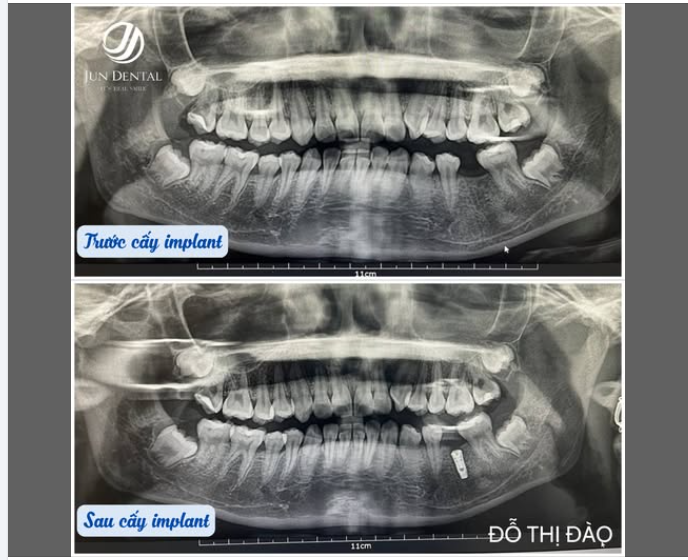 CA CẤY IMPLANT – KHÁCH HÀNG ĐỖ THỊ ĐÀO