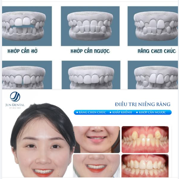 CHỈNH KHỚP CẮN NHẸ – GIẢI PHÁP TINH TẾ CHO NỤ CƯỜI TỰ NHIÊN